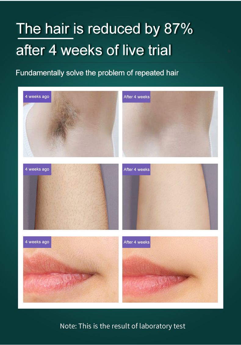 3 in 1 IPL Hair Removal & Skin Rejuvenation